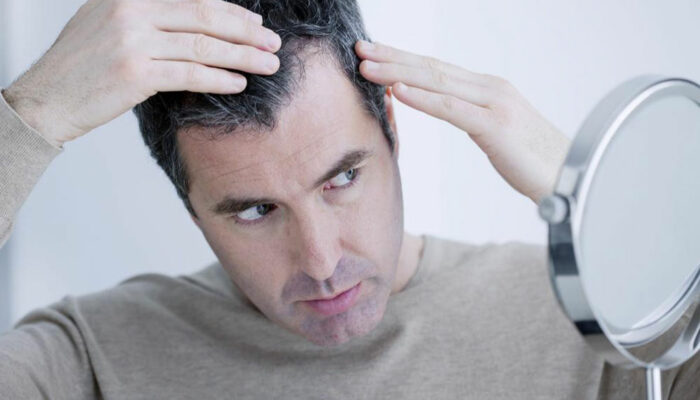 Top Symptoms and Stages of Male Pattern Baldness