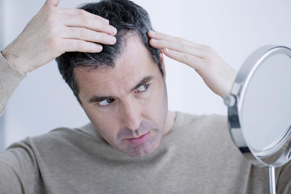 Top Symptoms and Stages of Male Pattern Baldness