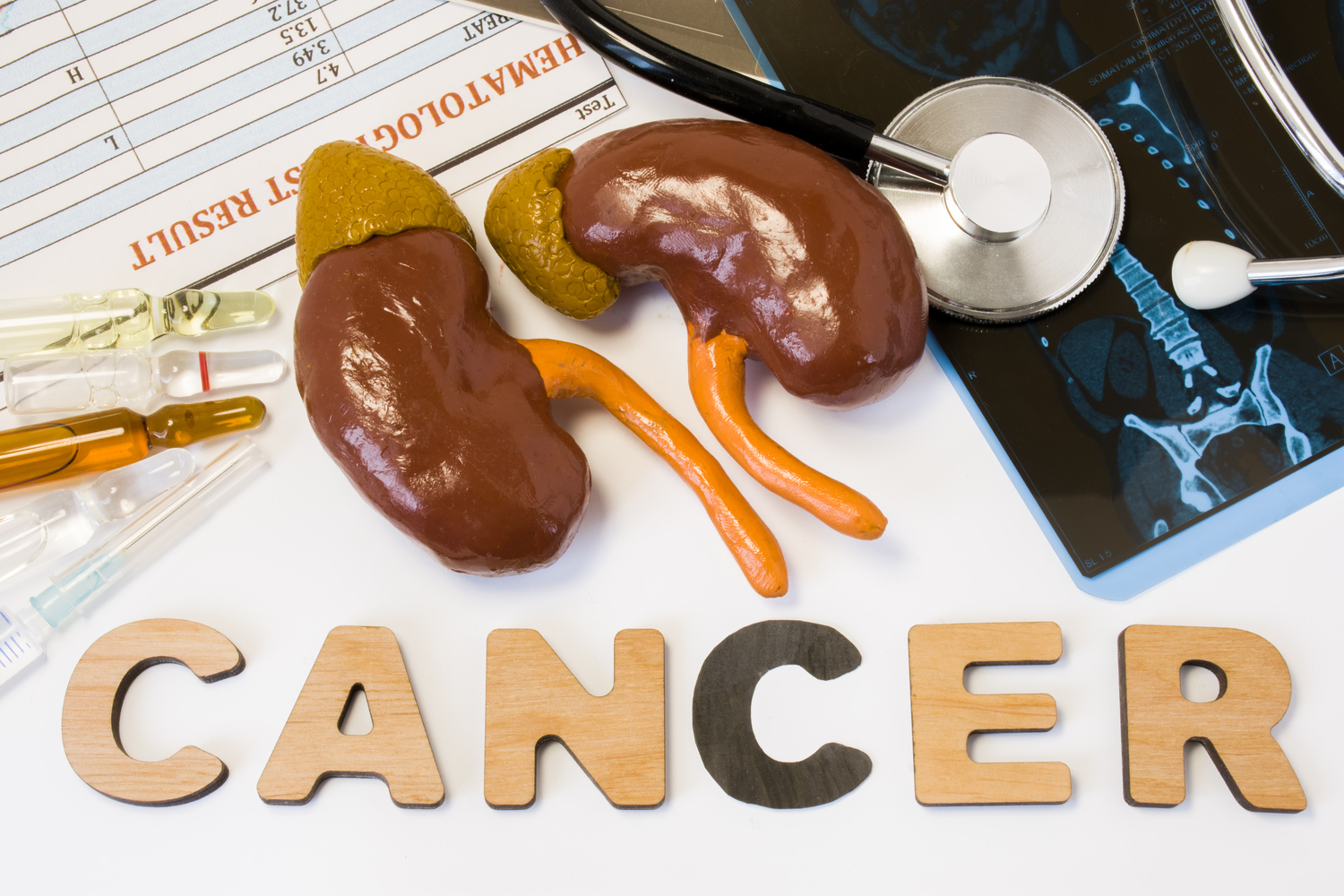 Kidney Cancer &#8211; Symptoms and Causes