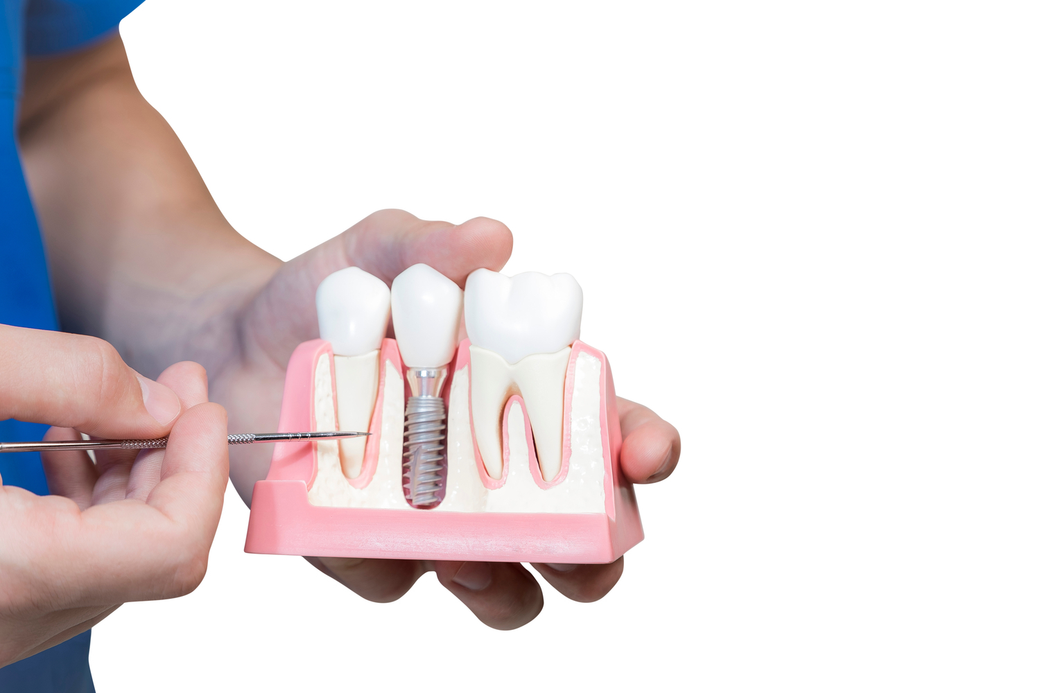 Dental Implant Cost: Instant Ways to Save on Dental Implants